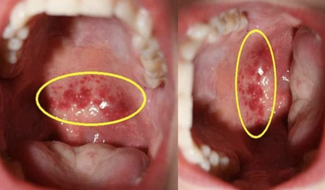 Viêm họng mãn tính: Nguyên nhân, triệu chứng, cách điều trị và phòng ngừa- Ảnh 1.